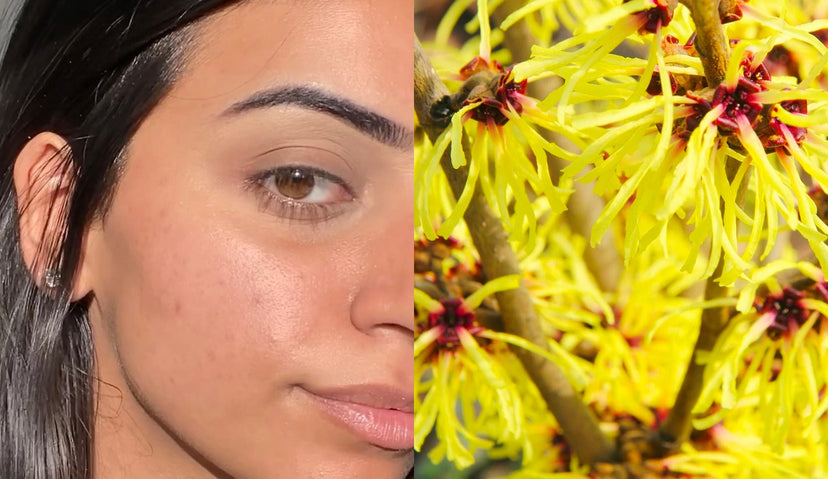 Witch Hazel Skin Benefits For Skin